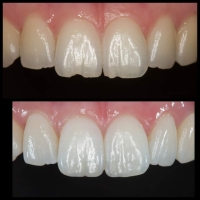 Реставрация и отбеливание зубов в стоматологии Оникс